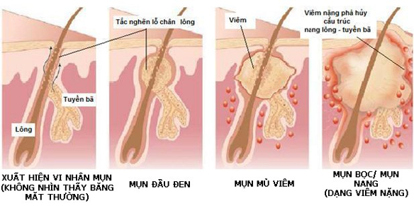 nhan-dien-4-yeu-to-gay-mun-dau-hieu-va-trieu-chung-thuong-thay-cua-da-mun