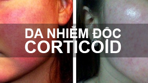 Đáng sợ triệu chứng viêm da do nghiện mỹ phẩm chứa Corticoid